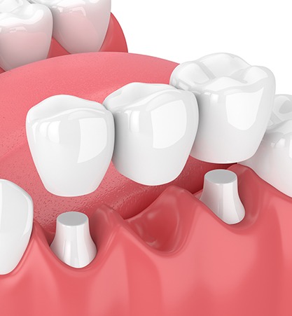 Calgary Dental Bridges | Monarch Landing Dental | Calgary, AB