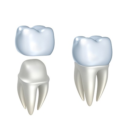 Dental Crown Calgary | Monarch Landing Dental | Calgary, AB