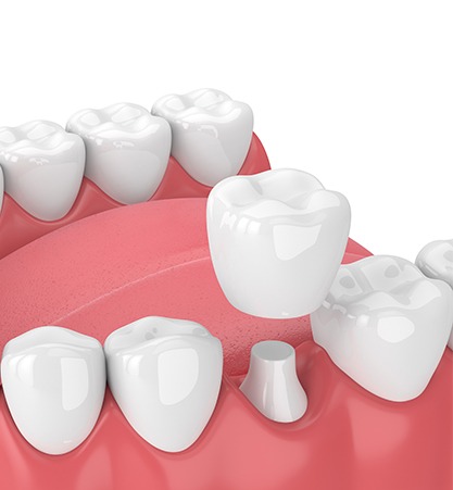 Dental Crowns | Calgary Dental Clinic | Monarch Landing Dental | Calgary, AB