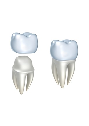 Dental Crowns | Calgary Dental Clinic | Monarch Landing Dental | Calgary, AB