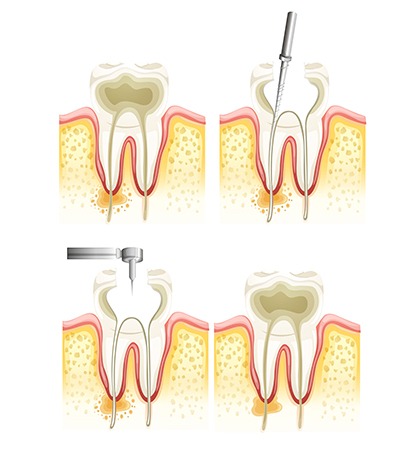 Root Canal Treatment Calgary | Monarch Landing Dental | Calgary, AB