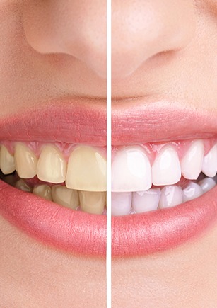 Teeth Whitening Care | Monarch Landing Dental | Calgary, AB