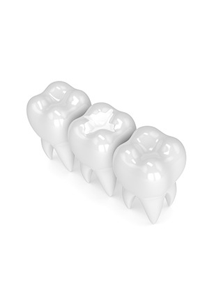 Tooth Coloured Fillings | Calgary Dentist | Monarch Landing Dental | Calgary, AB